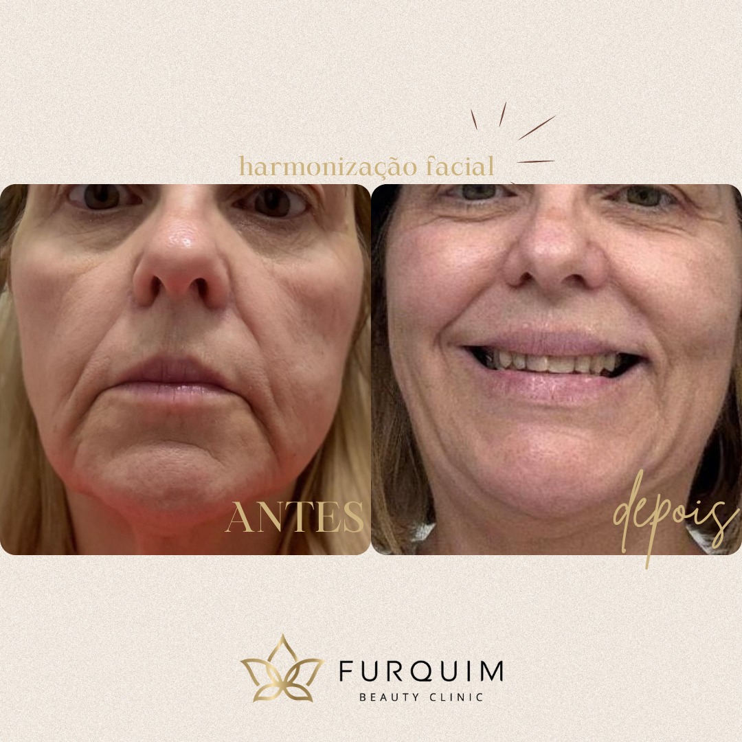Tratamento Facial